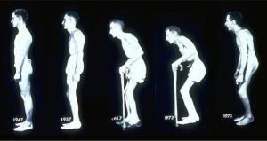Hva gjør en med Ankyloserende Spondylitt (AS)?